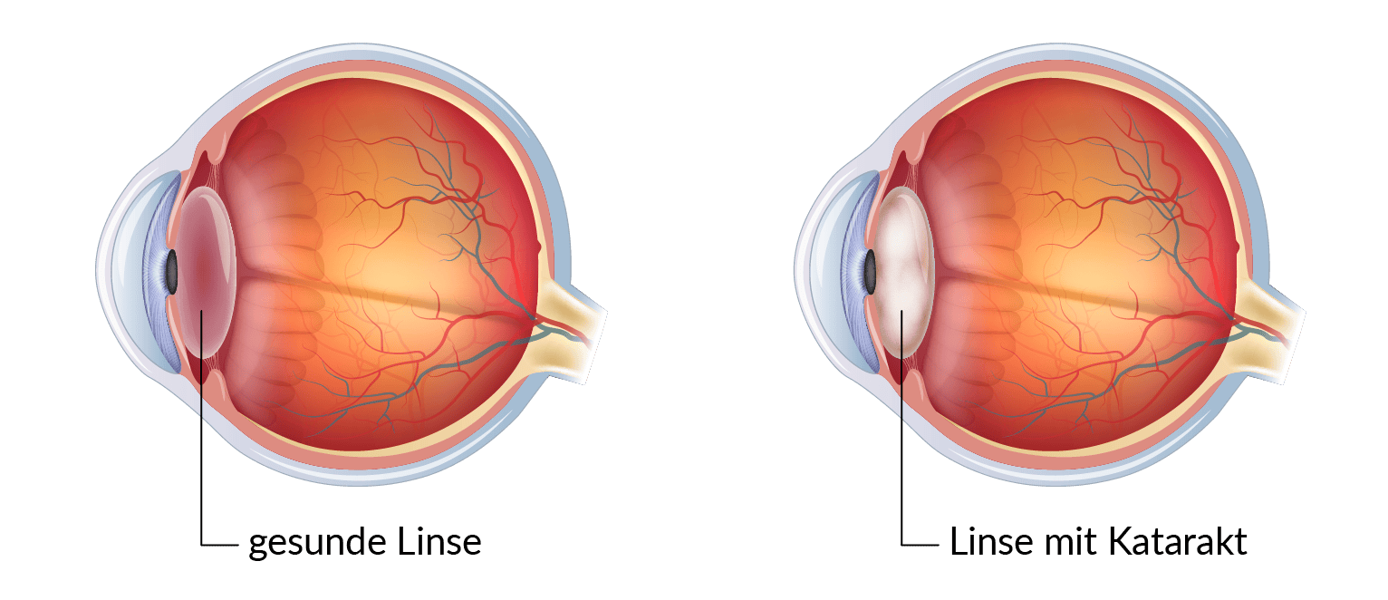 Vergleichsbild: Ein Auge ohne und eines mit Grauem Star.