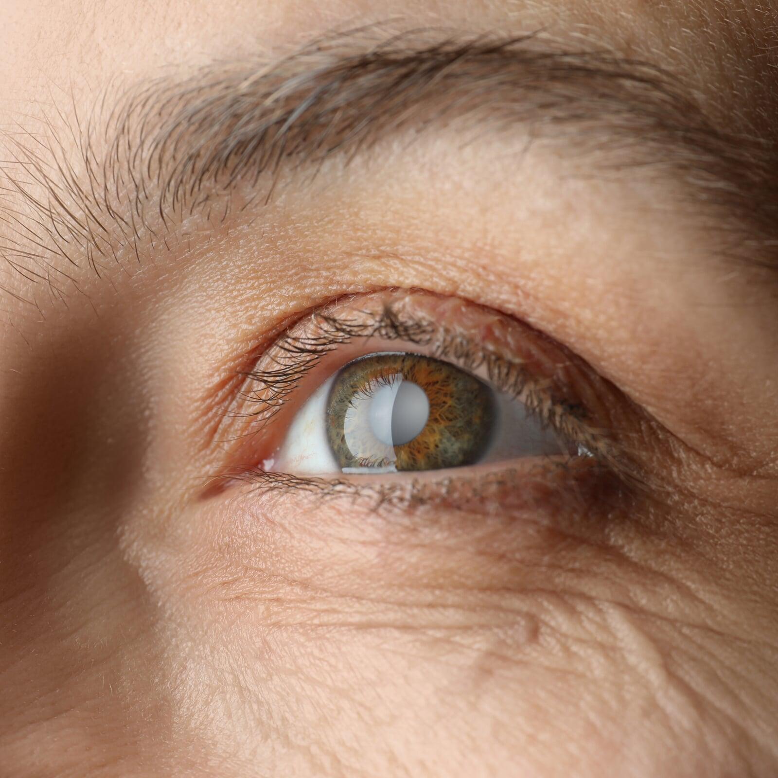 Das Bild zeigt ein Auge in Nahaufnahme, welches eine eingetrübte Linse hat.