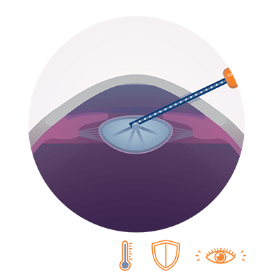 Grafik: schonende Entfernung der körpereigenen Linse durch den Nanolaser